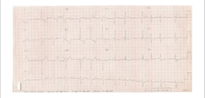 Fig. 3 – Electrocardiogram: atrial ibrillation, right-bundle branch block as well as of the anterosuperior division of the left-bundle branch and secondary alterations of  ventricular repolarization.