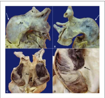 Fig. 6 — Macroscopía de los vasos de la base cardíaca, vistos de frente  en (A) y en posterolateral en (B)