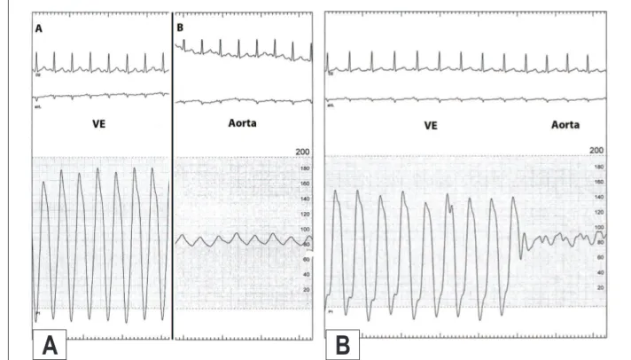 Figura 2A - Curva de presión del ventrículo izquierdo y de la aorta antes y 2B tras la valvuloplastia aórtica