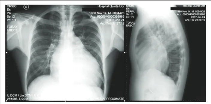 Figure 1 –  Chest X-ray in PA and proile showing a large increase in the cardiac area