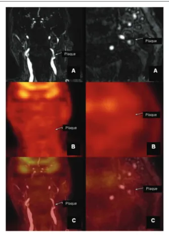Fig.  2  - Nenhuma  atividade  metabólica  foi  encontrada  na  fusão  das  imagens  por  18 F-FDG  PET  e  PET/MR  no  pescoço,  devido  ao  baixo  número de macrófagos
