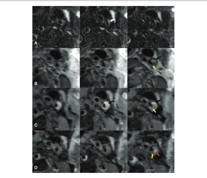 Figure 1 - In vivo transverse imaging of a left internal carotid artery. A - T2-weighted image shows a high-signal intensity region (arrow white); B and C - T1 and T1-FS  -weighted images show a high-signal intensity region (arrow black and yellow); D - Po