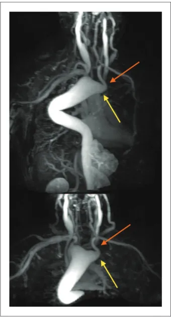 Figure 1 – Aortic arch at the right side (blue arrow) with rectal diverticulum  (yellow line) from where the left subclavian artery originates (orange arrow)