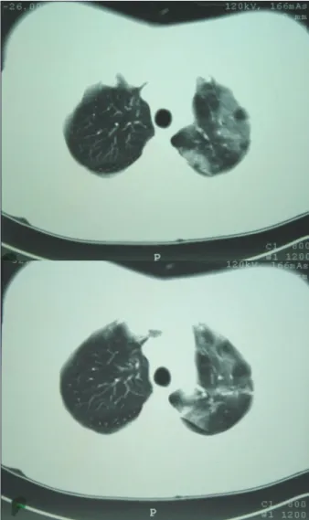 Figure 1 – CT-scan of the chest images showing extensive involvement of  the left lung with diffuse ground glass opacities.