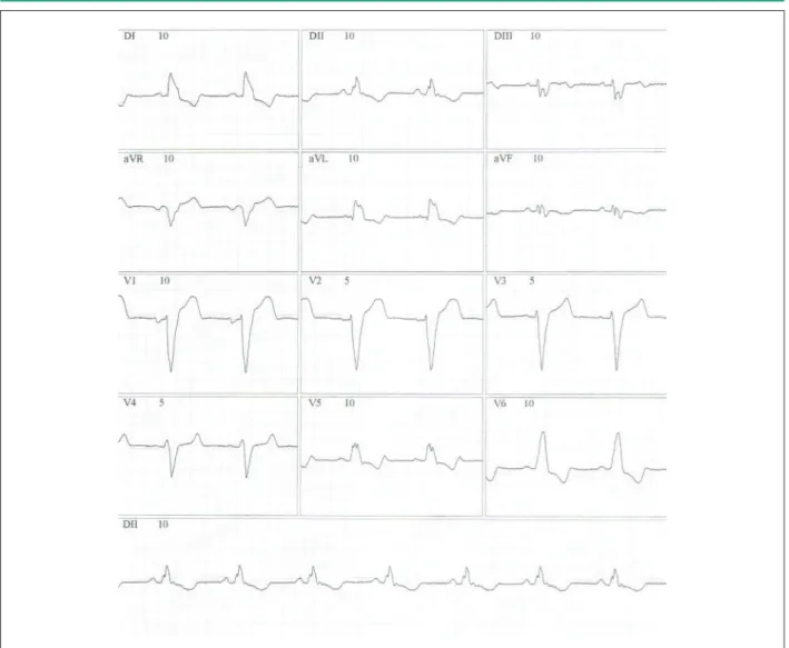 Figure 1 – Electrocardiogram of Patient 2 showing left bundle branch block pattern.