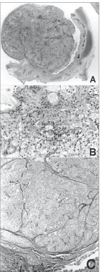 Figura  – Photomicrography of the mucous gland adenoma of the bronchus. Note the large tumor mass bulging into the lumen of the bronchus and in continuity with the mucosa (A)