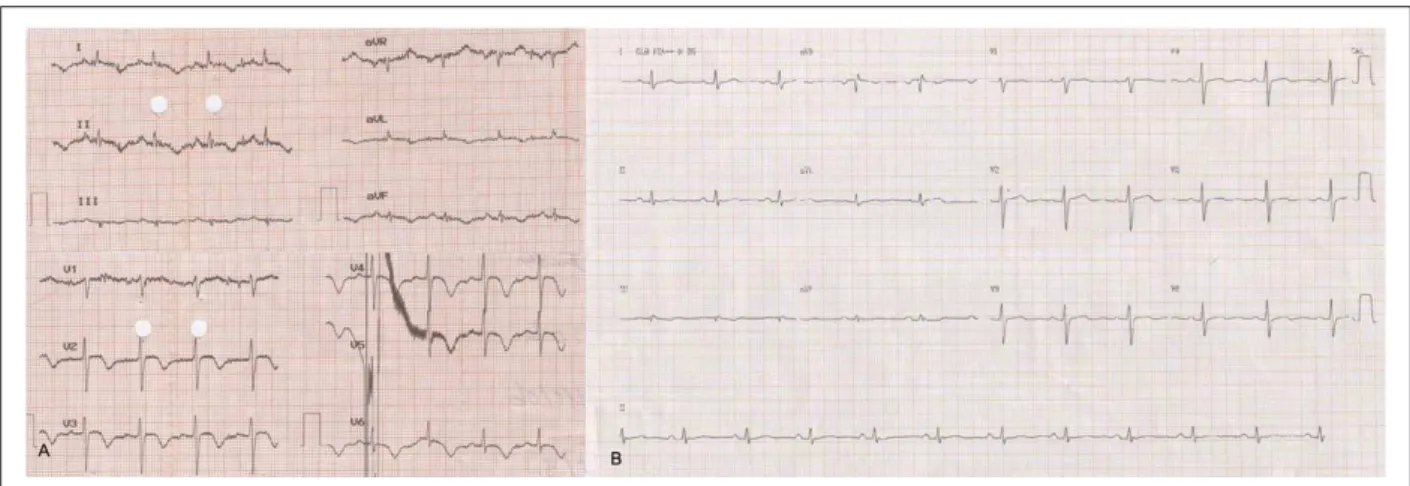 Figure 2 - Ventriculography in right anterior oblique view. A - Ventriculography performed in the acute event showing apical ballooning