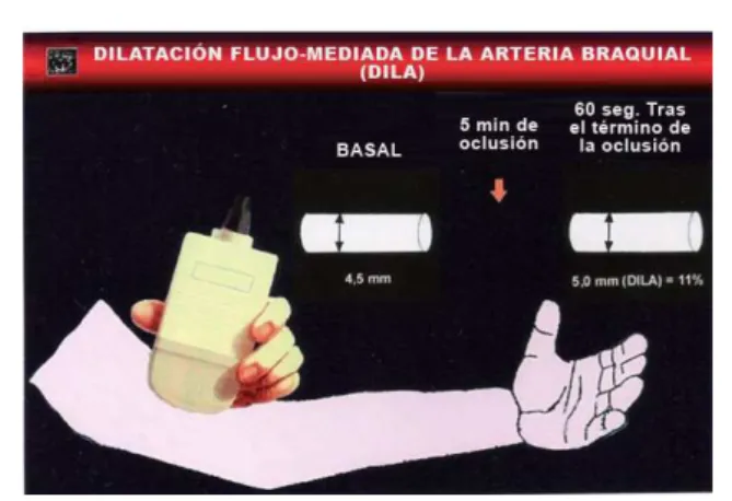 Figura 1 - Dilatación lujo-mediada de la arteria braquial.