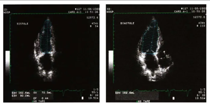 Figure 1 - Assessment of left ventricular function by two-dimensional method (A - systole, B - diastole).