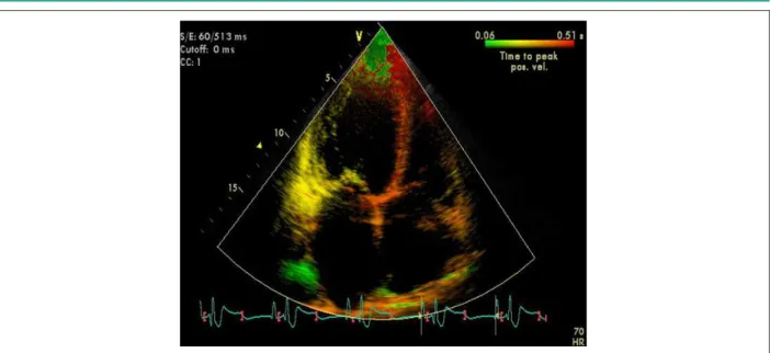 Figure 4 - Avaliação da dissincronia ventricular pela técnica de sincronização tecidual.