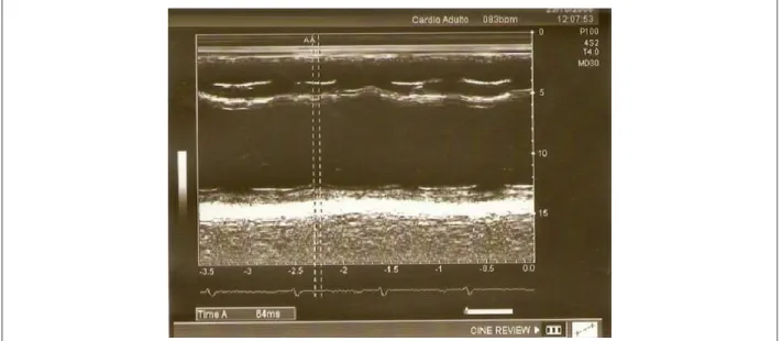 Figure 3 -  Evaluación de la disincronía intraventricular por el modo M.