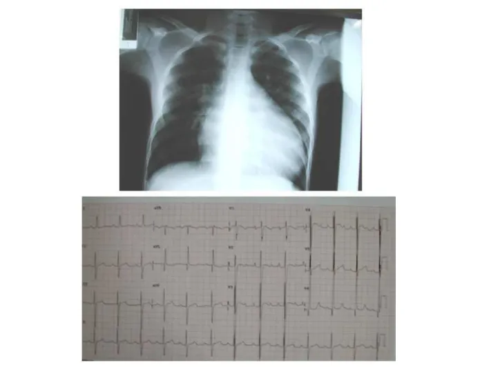 Figure 1 - Radiographic image shows an increased cardiac area, mainly in the left cavities, with rectiication of the medium arch and pulmonary arteries slightly increased