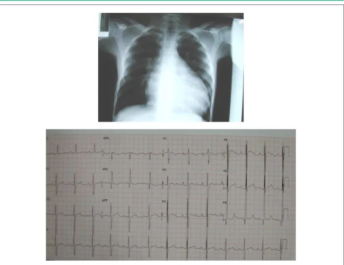 Fig. 2 - El ecocardiograma muestra el aumento exagerado de las cavidades cardíacas izquierdas con discontinuidad acentuada del septo atrial y también del septo  ventricular en vía de entrada, en proyección paraesternal en cuatro cámaras
