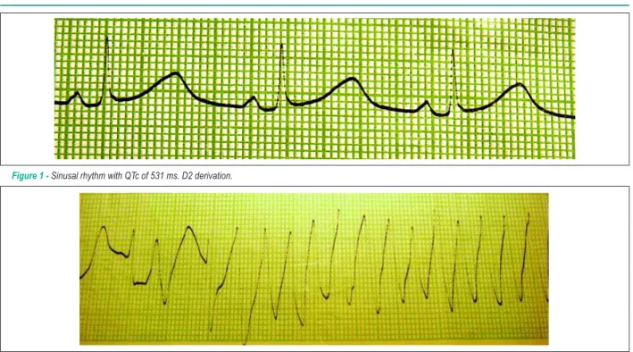 Figure 1 - Sinusal rhythm with QTc of 531 ms. D2 derivation.