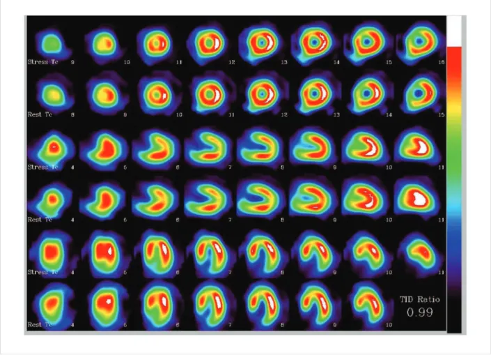 Fig. 1 – Radionuclide imaging of patient under physical stress and in repose, demonstrating left ventricle cuts without perfusion defects