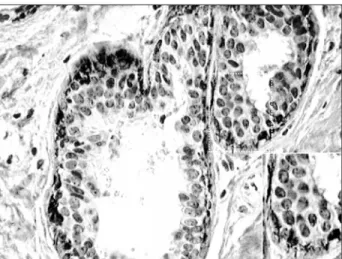 Figura 2 – Expressão da P-caderina num carcinoma invasivo da mama de alto grau