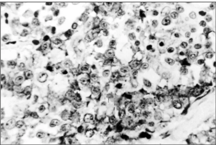 Figura 2 – Linfoma T periférico: imunopositividade de membrana celular com o