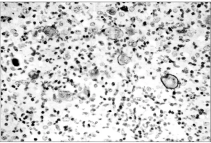 Figura 4 – Linfoma anaplásico de grandes células: imunopositividade de membrana