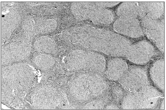 Figura 6 – Linfoma T periférico: linfócitos pleomórficos de tamanho pequeno, médio
