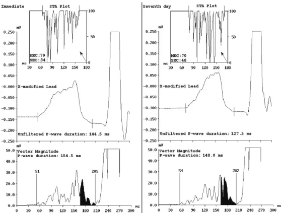 Figure 2 – The frequency and time domain analysis of P-wave signal-averaged ECG (SAECG)
