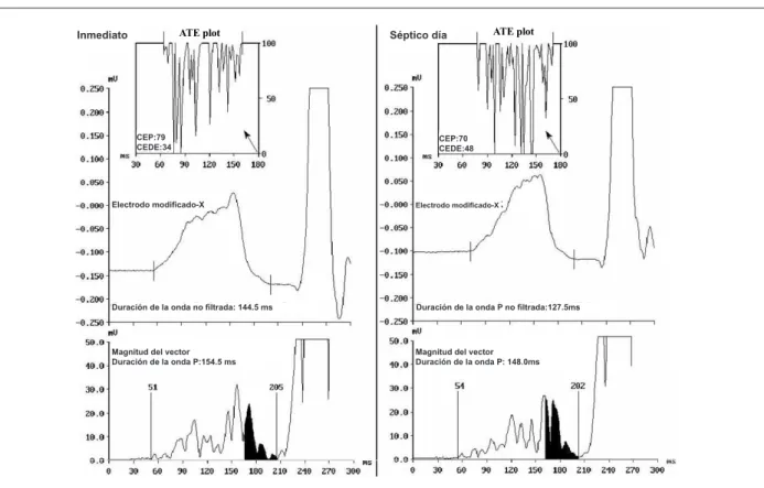 Fig. 2 – La frecuencia y el análisis del dominio de tiempo del P-ECGAR. En la columna de la izquierda, desde arriba hacia abajo, el análisis de la turbulencia espectral  (ATE plot), el electrodo modiicado X en el iltrado y la magnitud de vector (MV) iltrad