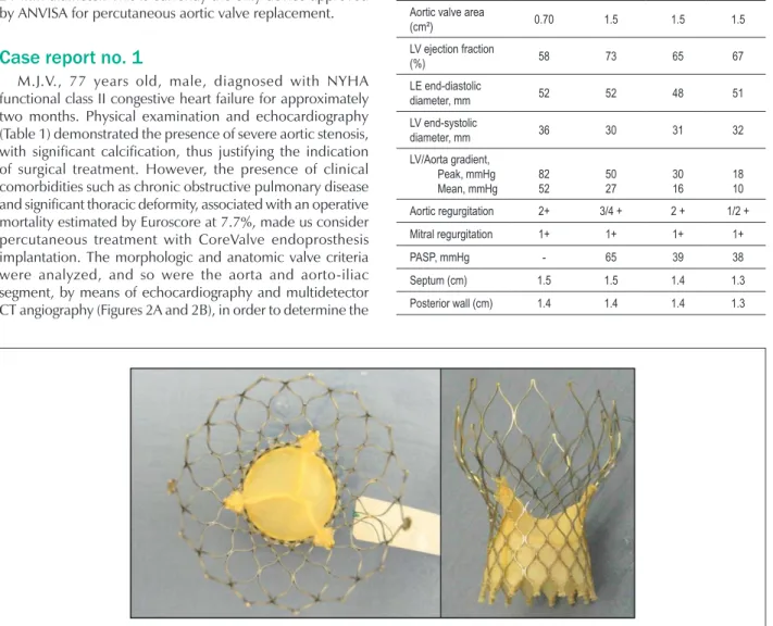 Table 1 - Pre-procedural, immediate post-procedural and follow-up  echocardiographic parameters