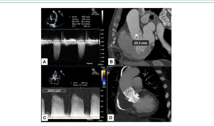 Figure 2 - Pre-intervention echocardiogram (A) and CT angiography (B) showing calciic aortic valve stenosis and valve annulus measuring 25mm