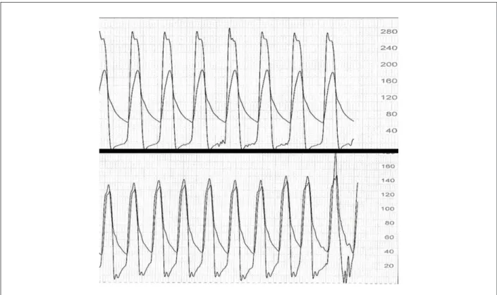 Figure 7 - Pressure curves pre (A) and post (B) CoreValve prosthesis implantation, showing reduction of the systolic aortic transvalvular pressure gradient.