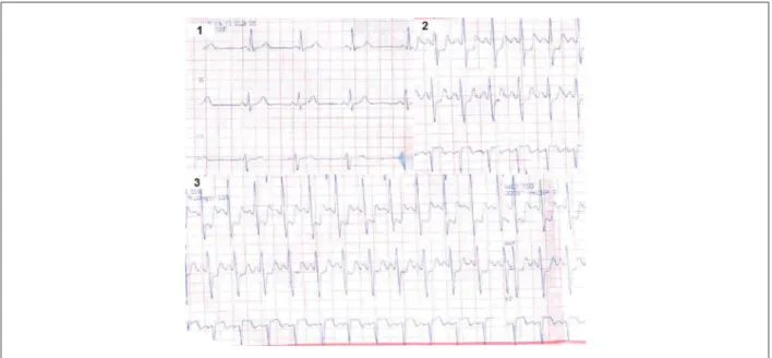 Figure 02 - Ergometric testing. Box 01 shows resting pre-stress recording. Box 02: recording on the third minute of the irst stage of Ellestad with pain and BP: 120/60mmHg