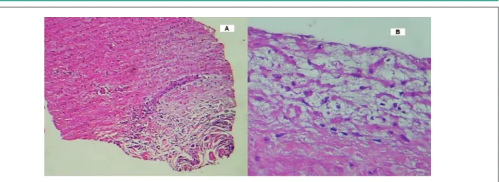 Figure 07 - Histological section of the aorta. A: section showing the endothelial surface with intimal thickening