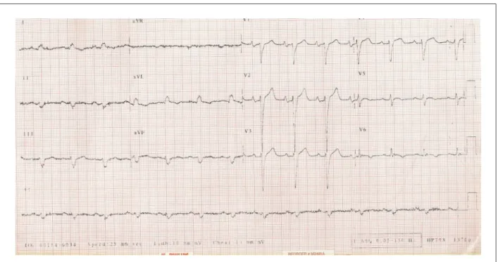 Figure 1 - ECG: sinus rhythm and low-amplitude R-waves in the frontal plane and precordial leads; intraventricular conduction abnormality; left ventricular and atrial  overload