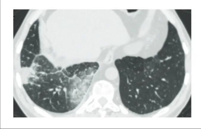 Figure  5  - Tomographic  view  of  lung  bases  showing  wedge-shaped  consolidations with pleural base in the right lower lobe surrounded by  ground-glass opacities, consistent with infarct areas and pulmonary hemorrhages.