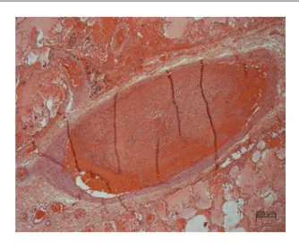 Figure 6 - A - Longitudinal section of the heart showing globoid shape with  dilated cavities