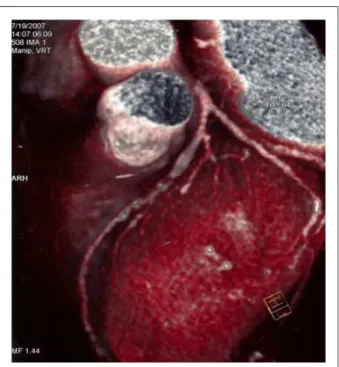 Fig. 1 - Angiotomografía de coronaria mostrando lesión proximal de la arteria  descendente anterior.