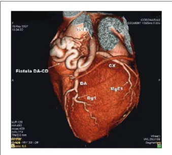 Fig. 1 - Coronary Computed Tomography Angiogram showing a large coronary  artery istula.