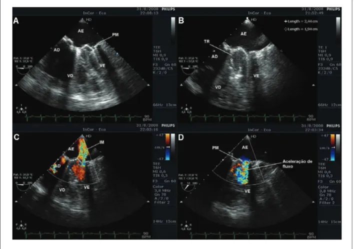 Fig. 1 – A and B - Transesophageal echocardiogram showing large thrombus adhered to the prosthetic mitral valve with reduced area; C - moderate paraprosthetic leak  on color-Doppler-low mapping; D - clear low acceleration consistent with reduced prosthetic