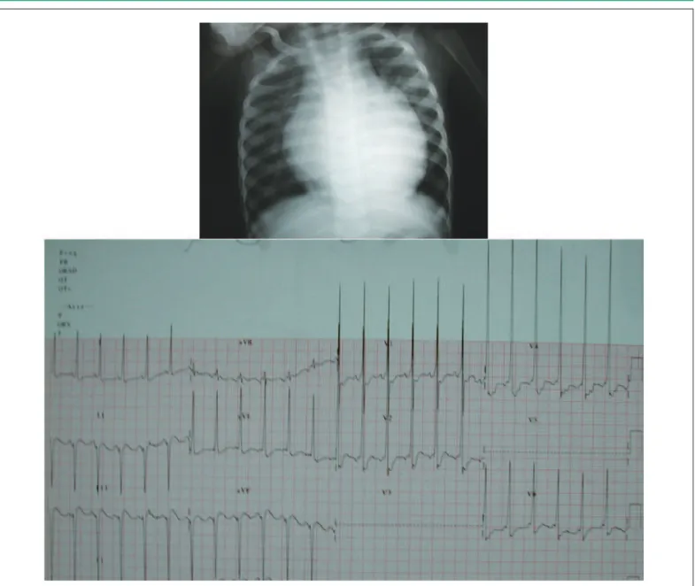 Fig. 2 - O ecocardiograma mostra o aumento exagerado das cavidades cardíacas esquerdas, com os septos atrial e ventricular deslocados para a direita em projeção  paraesternal em quatro câmaras, em A