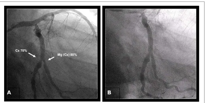 Fig. 2 - A - Proyección oblicua anterior derecha, arteria circunleja (Cx) con obstrucción del 70% y marginal izquierda Mg(Cx) con obstrucción del 80%; B - Resultado de las  angioplastias coronarias, con éxito.