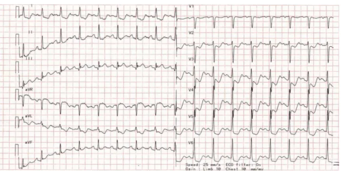 Figure 2 - Normal Left Anterior Descending and Circumlex arteries.