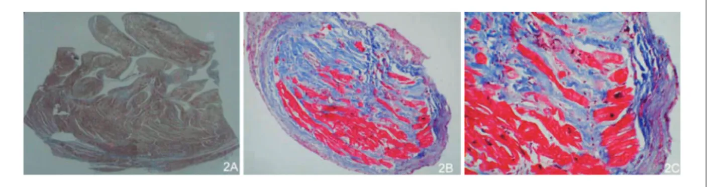 Figura 2 -  Corte histológico coloreado tricromo de Masson mostrando la capa epicárdica compactada y la capa endocárdica no compactada