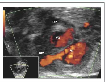 Figura  1  –  Ecocardiograma fetal demostrando divertículo en ápex del  ventrículo izquierdo y derrame pericárdico; DIV: – divertículo; VD: – ventrículo  derecho; VI: – ventrículo izquierdo; DP: – derrame pericárdico.