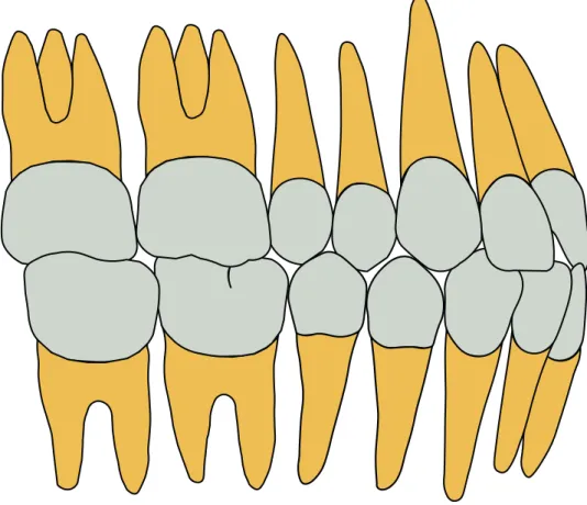 Figura 1: Relação Classe I de Angle. Cúspide mesiovestinular do primeiro molar  superior ocluindo no sulco mesiovestibular do primeiro molar inferior.