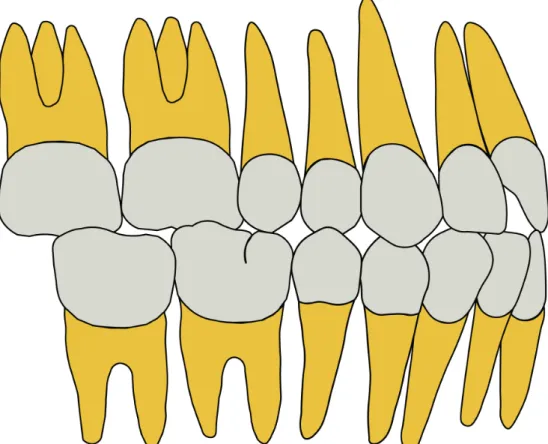 Figura 3: Relação Classe II de Angle. Cúspide mesiovestinular do primeiro molar superior  ocluindo na mesial do sulco mesiovestibular do primeiro molar inferior.