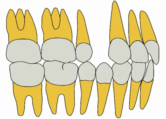 Figura 6: Esquema exodontia primeiro pré-molar superior.