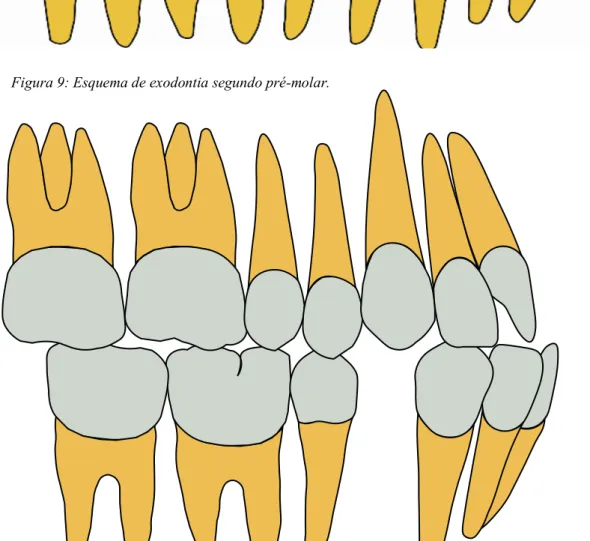 Figura 8: Esquema de exodontia apenas do primeiro pré-molar inferior.