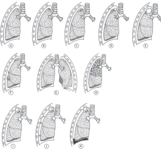 Figura 3.  Imagem videotoracoscópica de bolha enfisematosa  subpleural com extremo adelgaçamento em ápice pulmonar  esquerdo, associada à aderência pleural.