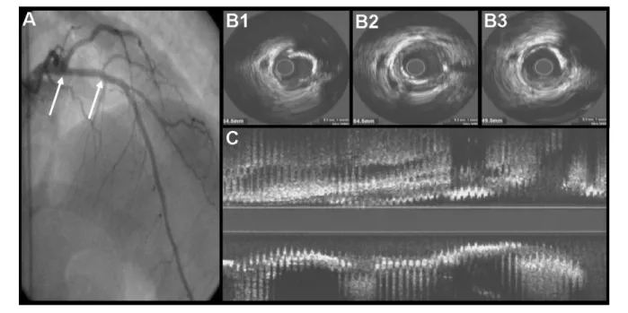Figure 1 -  A - Left coronary artery angiography displaying the left anterior descending artery with mild atherosclerosis