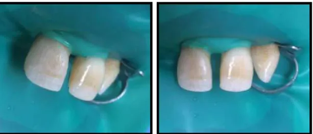 Figura 56 – Restauração final do dente 11   Figura 57 – Restauração final do dente 11  