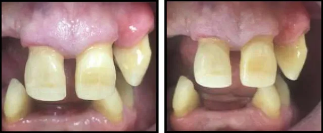 Figura 64 – Polimento final do dente 11  Figura 63 – Polimento final do dente 11  