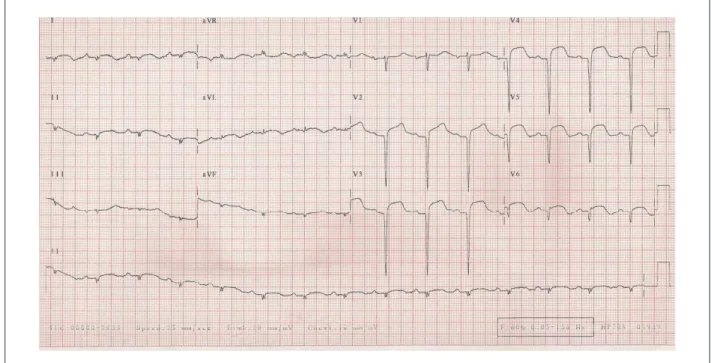 Figure 1 - ECG - low-voltage QRS complexes in the frontal plane, extensive anterior and inferior-wall areas that were electrically inactive and ST-segment elevation in I,  aVL and from V 1  to V